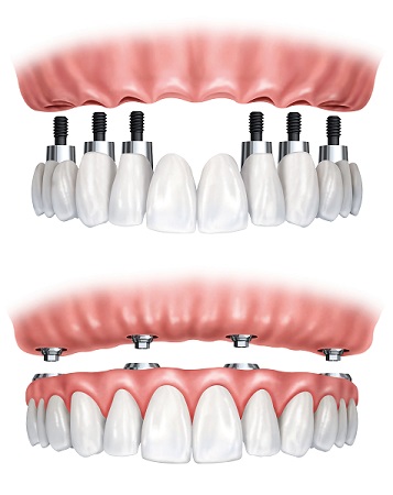 Implant full arch teeth glasgow