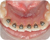lingal braces