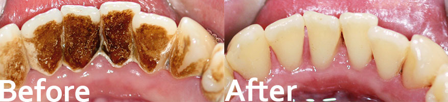 Stain removal teeth