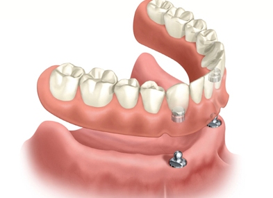implant retained denture glasgow