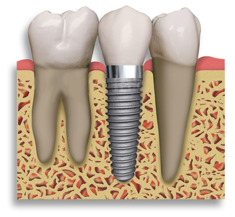 Dental Implant Glasgow